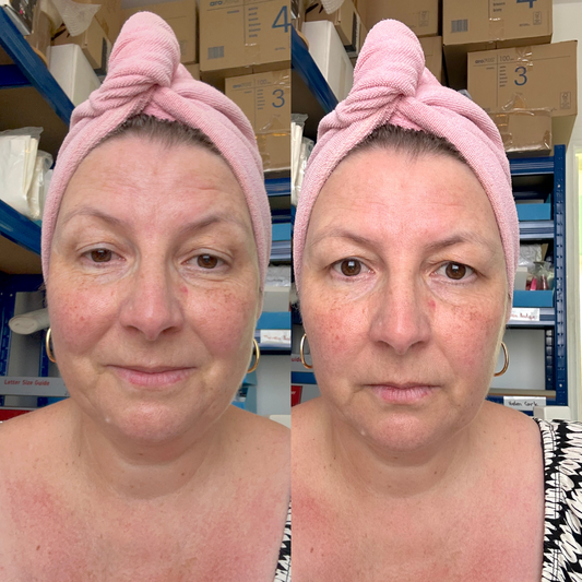 eye wrinkle filler review