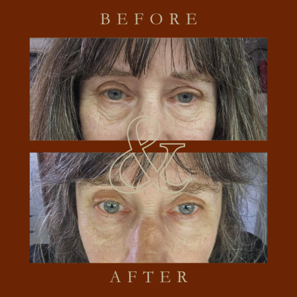 Before and after comparison of a woman's face with visible aging signs on a brown background.
