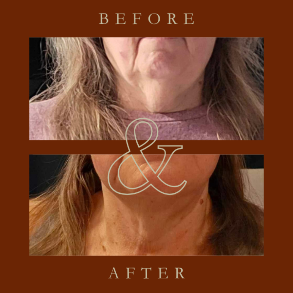 Before and after comparison of neck skin texture with a large ampersand symbol.